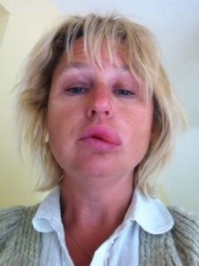 Early angioedema