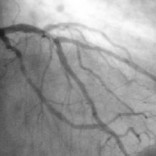 New STEMI Guidelines