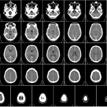 JC: Do paediatric CT scans cause cancer? St.Emlyn’s