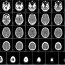 JC: Do paediatric CT scans cause cancer? St.Emlyn’s