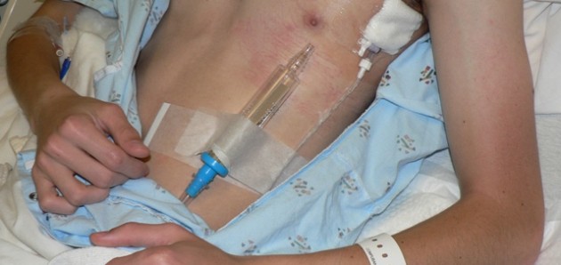 JC: Should we use Heimlich Valves for ambulatory pneumothorax management? St. Emlyn’s