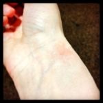 Bruised Wrist